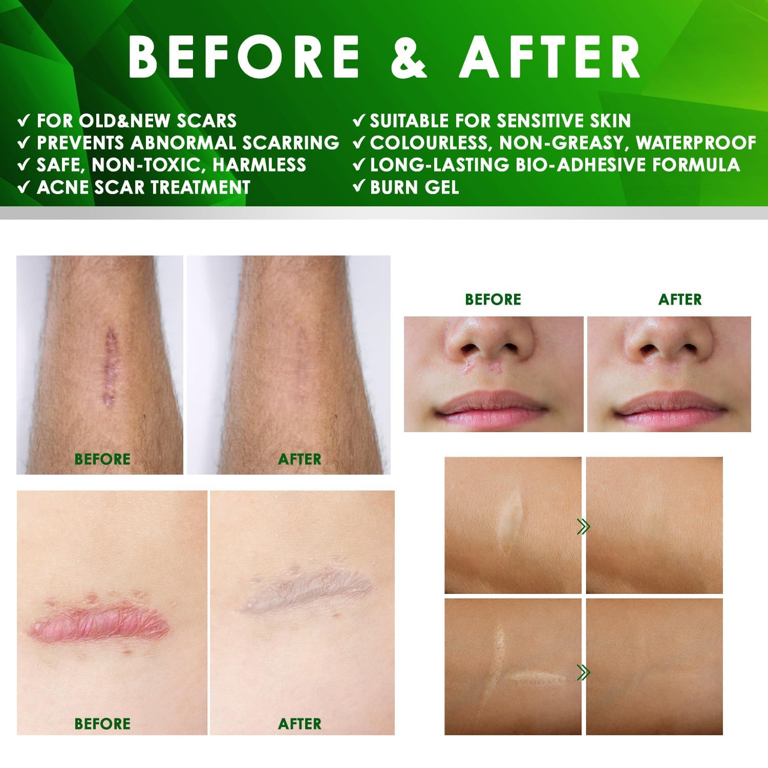 Tobcharm Advanced Keloid Bump Removal Gel | Silicone Scar Treatment for Piercing, Surgery, Acne, Burns | 30g