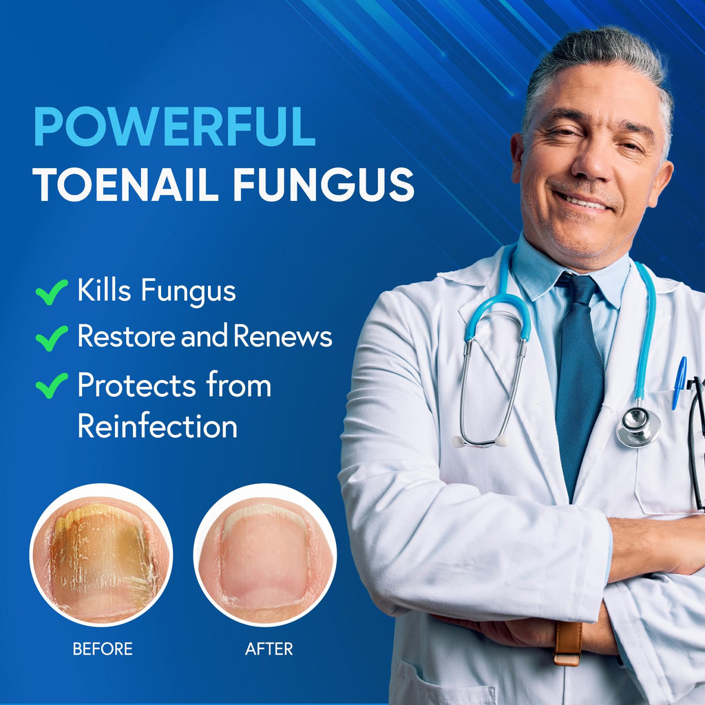 Tobcharm Toenail Fungus Treatment Extra Strength – Tea Tree Oil & 25% Undecylenic