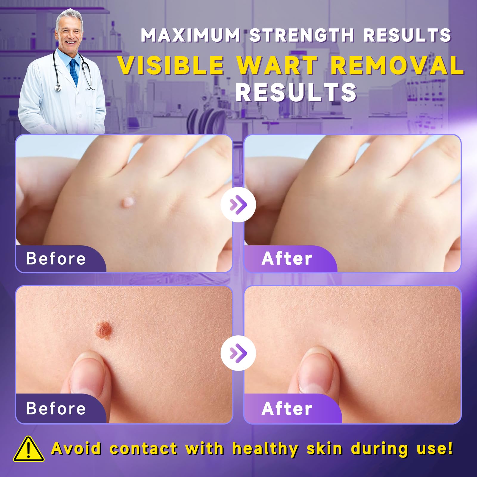 TTsiya Wart Remover Freeze Off – Fast-Acting Salicylic Acid Liquid (30 ml)