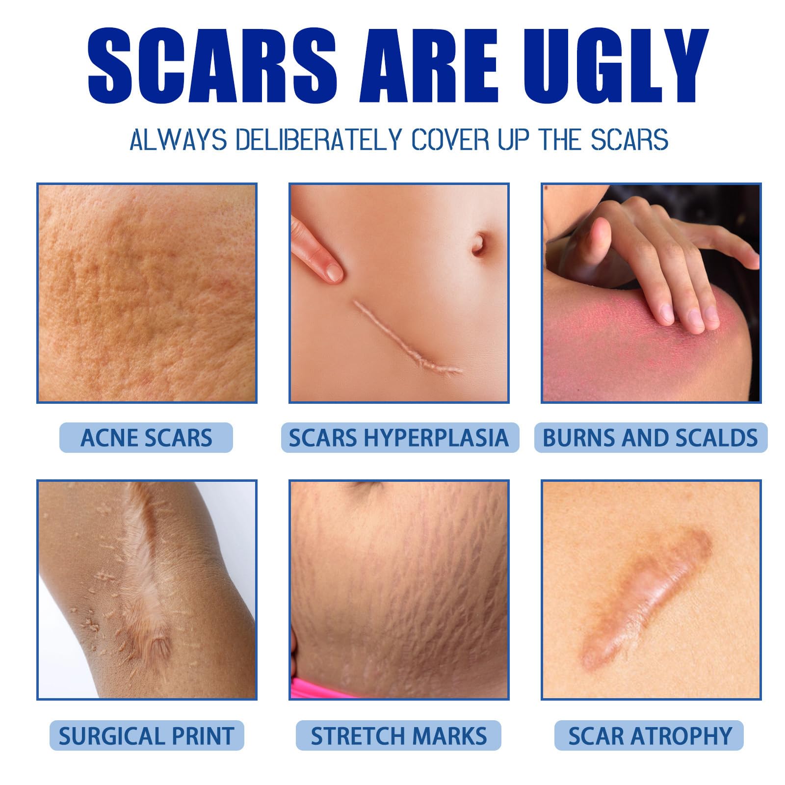 URABOS Scar Cream + Silicone Gel — Scar Treatment for Surgical Scars, Stretch Marks & Keloids (2pcs)