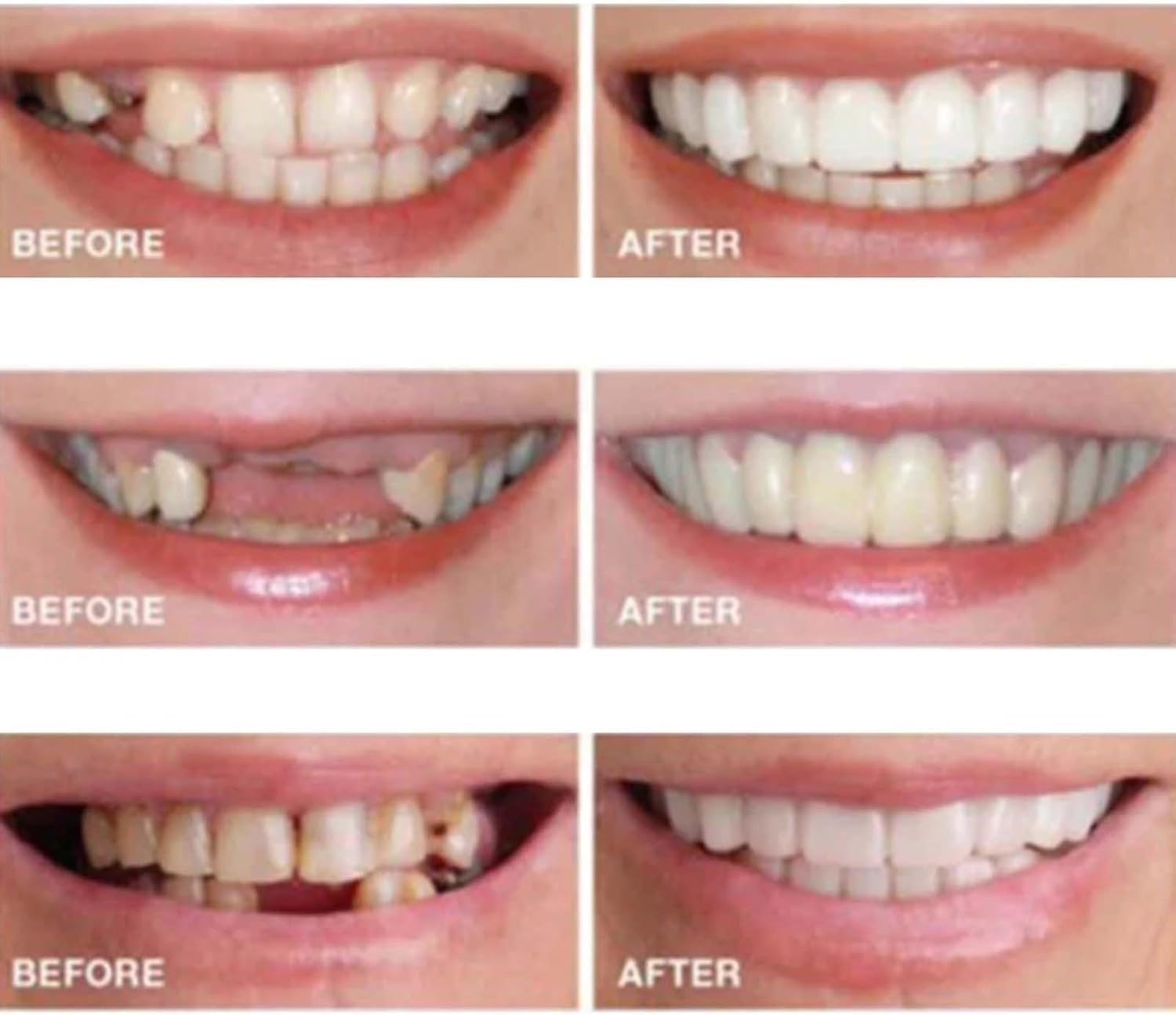 2 Pairs Temporarily Adjustable Smile Aligners – Natural & Comfortable for Men & Women (White)