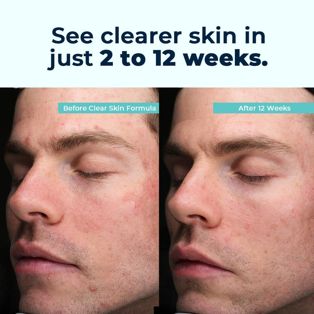 VitaMedica Clear Skin Vitamin Formula — Noncystic Acne Support (2 Pack)
