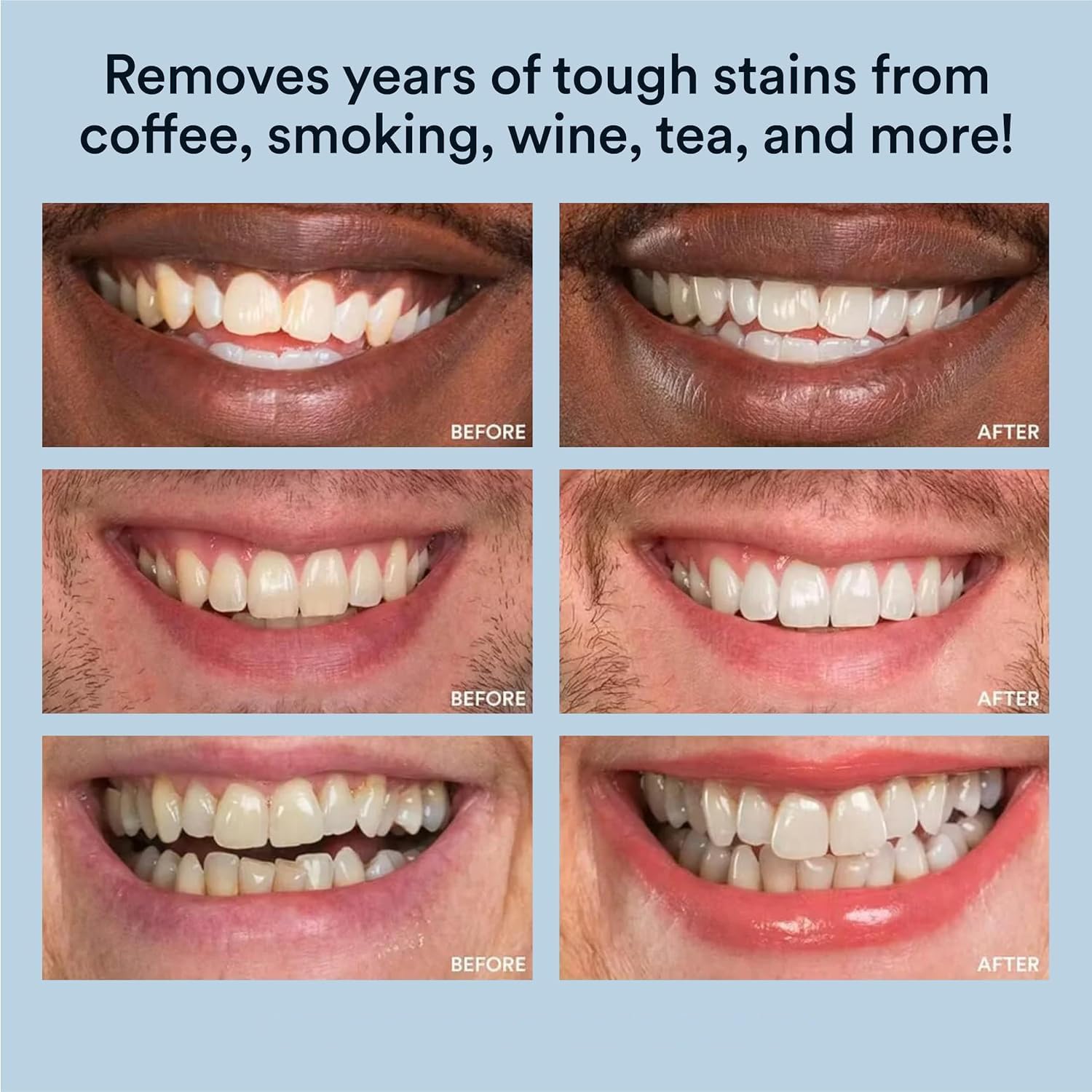 WHITE SMILE Teeth Whitening Kit – LED Light System, 35% Carbamide Peroxide, 3 Gel Syringes