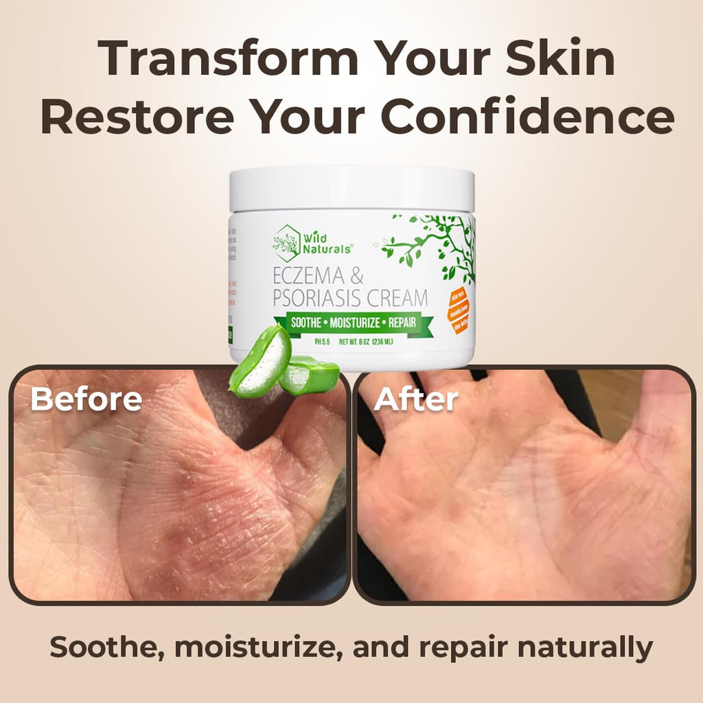 Wild Naturals Eczema & Psoriasis Cream with Manuka Honey – Hydrating, Gentle Relief