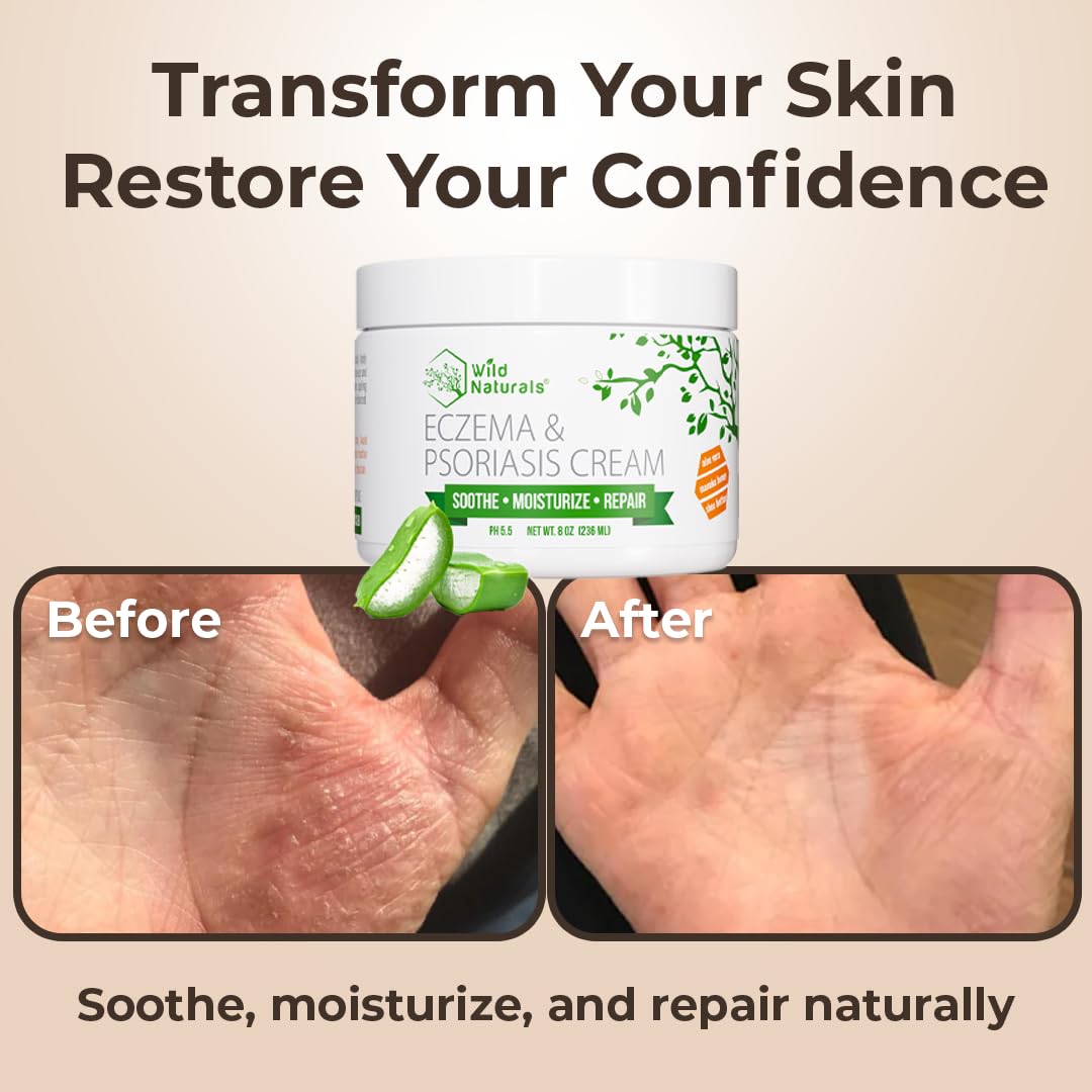 Wild Naturals Eczema & Psoriasis Cream — Manuka Honey + Aloe, Hydrating Lotion for Dry Skin (Adults & Kids)