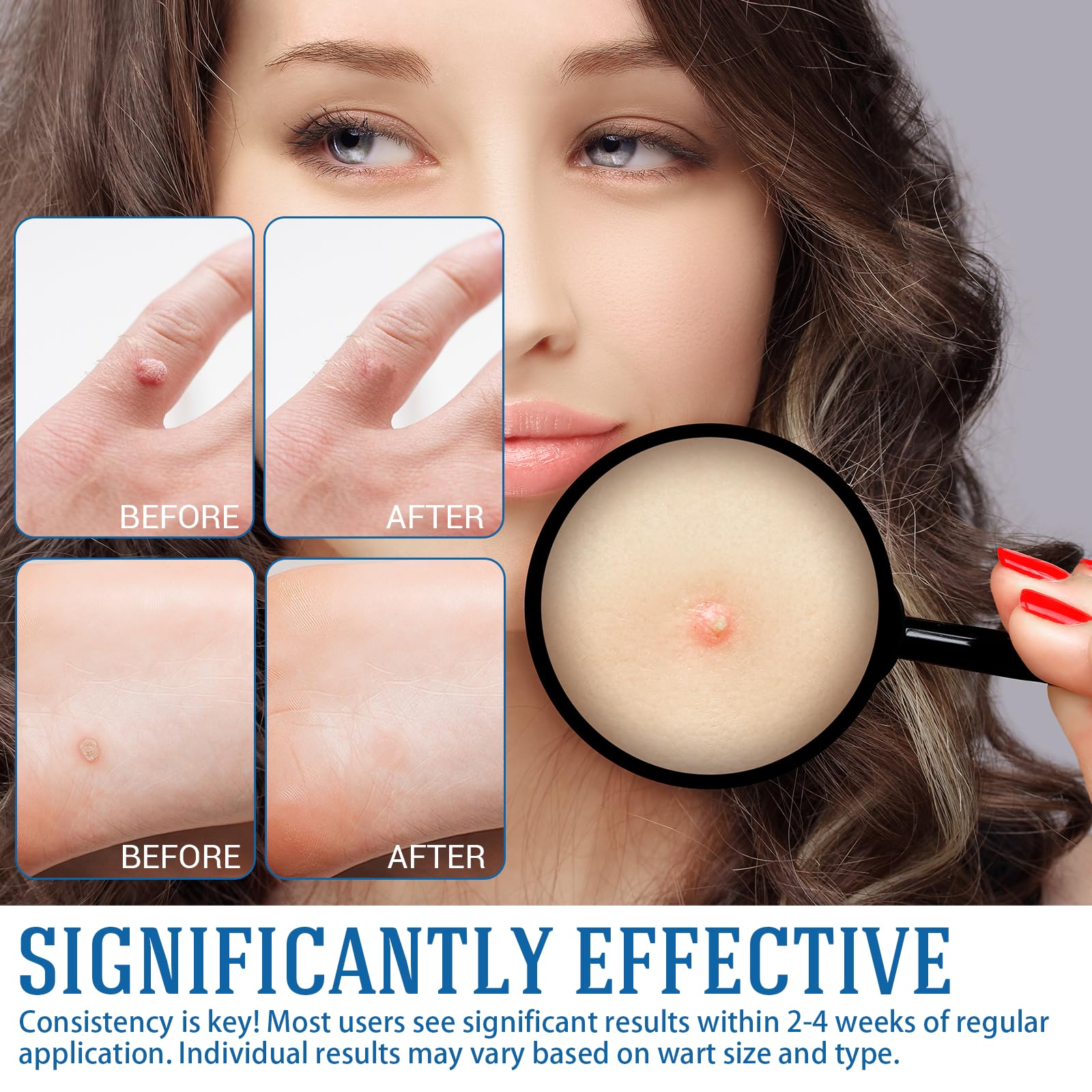 YEHOYOD Fast-Acting Skin Tag Removal Kit - Gentle, Pain-Free, Fast Results