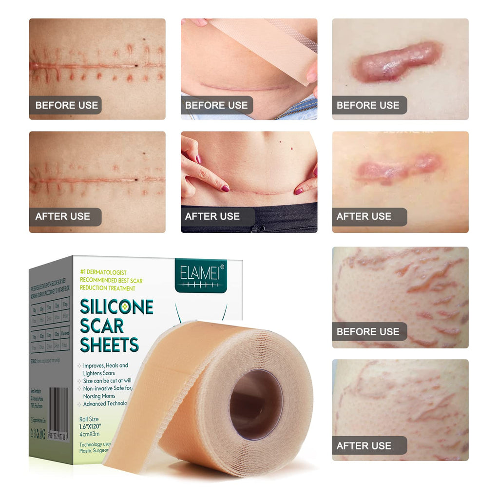 ZODENIS Silicone Scar Sheets – 1.6” x 120” Roll (3M) for Scar Care