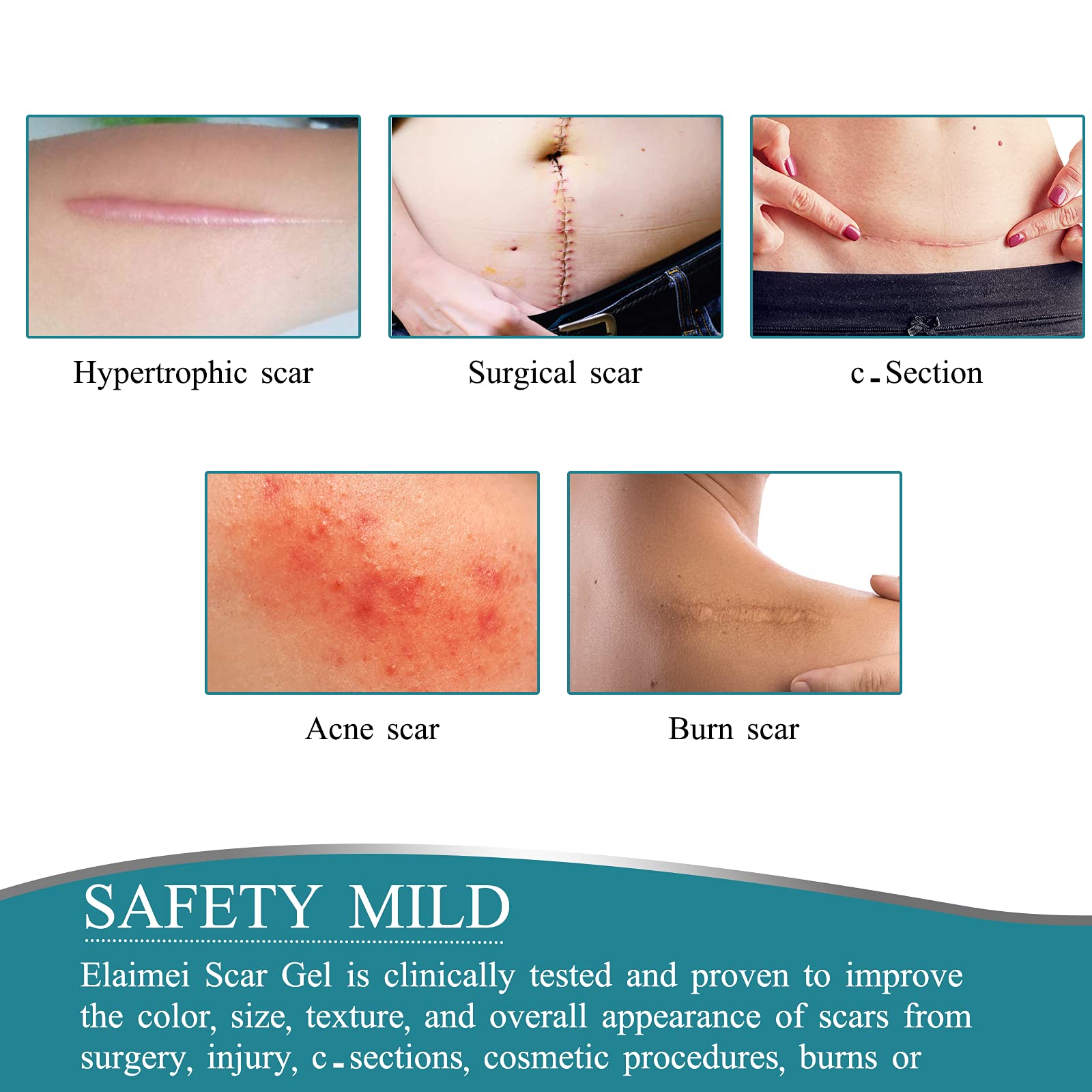 ZODENIS Medical Grade Silicone Scar Tape – 1.6” x 60” Scar Sheets (6–8 Month Supply)